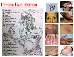 liver diseases