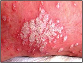 Yeast store blood infection