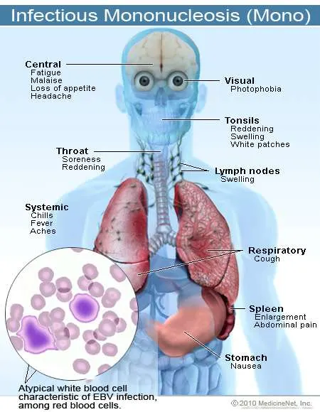 2011-infectious-mononucleosis
